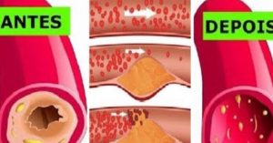 Com essa receita caseira você vai limpar as artérias do coração e prevenir o infarto e ataque cardíaco