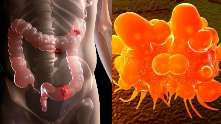 Câncer de Intestino: É letal sem diagnóstico precoce; 7 sintomas que JAMAIS deve ignorar